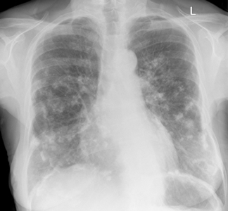 Lungs after asbestos exposure